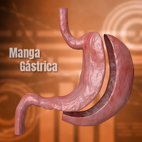 Gastrectomia vertical o Manga gastrica cirugia bariatrica en Colombia tambien llamada sleeve gastrico muy util para bajar de peso