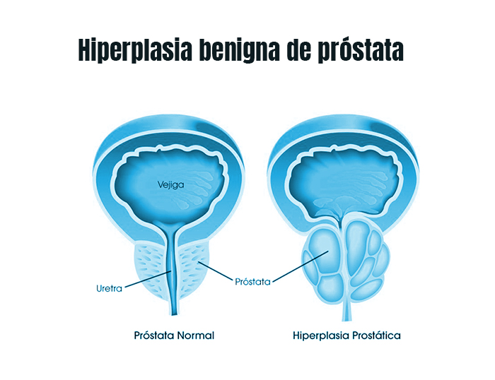 prostaa agrandada prostata sana