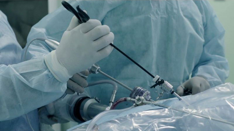 En que consiste la ciruugía bariátrica laparsocópica que es video laparoscopia