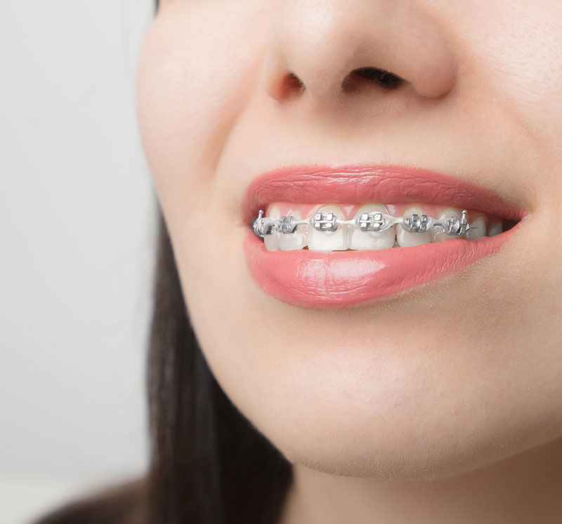 mujer sonriendo con brakets ortodoncia