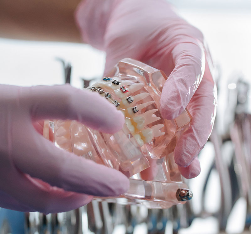 manos de odontologo que aplican brakets para mejroar los dientes