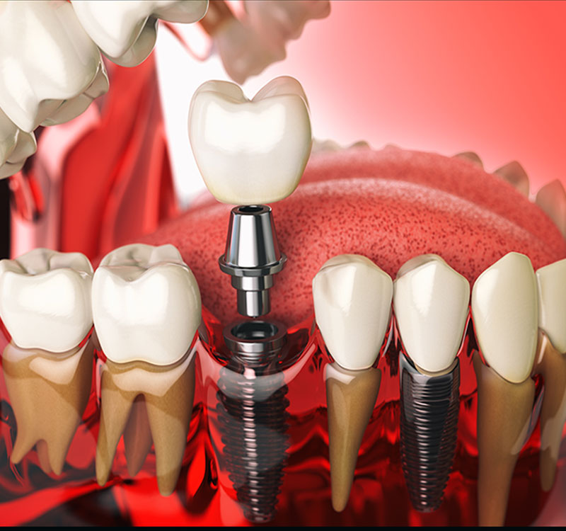 implantes dentales dientes implantologia dental