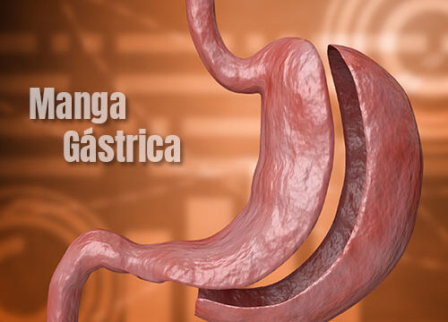 cirugia bypass gástrico, pros y contras manga vs bypass desventajas antes y después sus puntos claves y preguntas frecuentes en Colombia