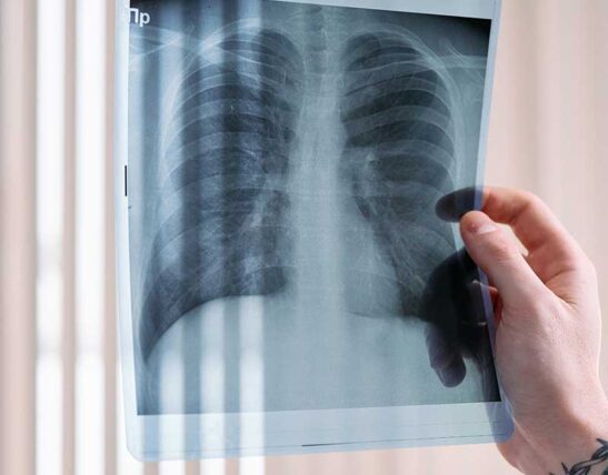 Qué es la cirugía de tórax en colombia Pulmón, Pleura, Tráquea Mediastino Diafragma, Estructura ósea