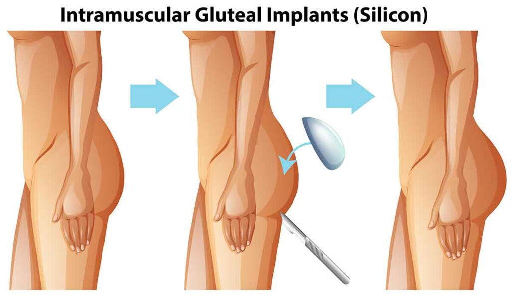 en que consiste la gluteoplástia con implantes cirugía de la cola con implantes en coombia